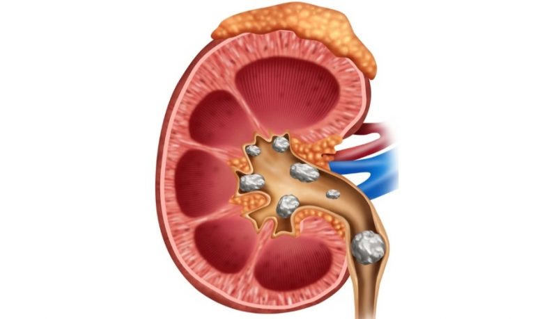 What to Avoid on a Kidney Stone Diet: Foods High in Sodium, Oxalate, and Animal Protein